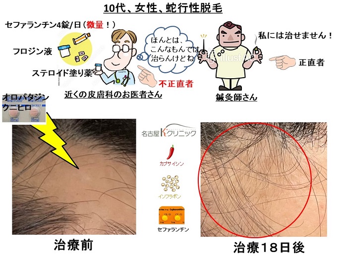 円形脱毛症　病院